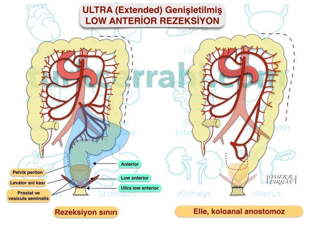 Ultra (extended genişletilmiş) low anterior rezeksiyon